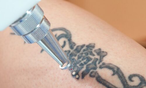 Getting Around the World of Best Tattoo Removal